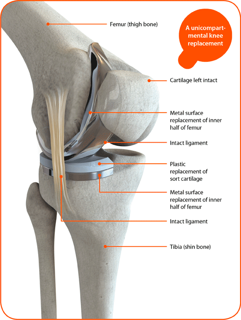 Knee-Replacement