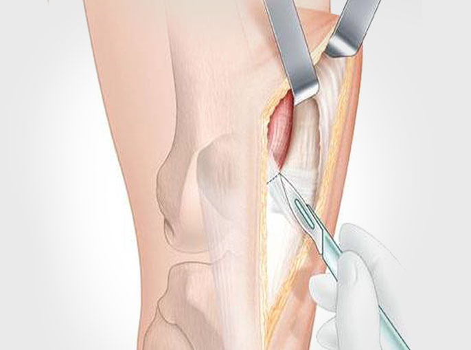 Muscle Sparing - Subvastus Knee Replacement, Mumbai