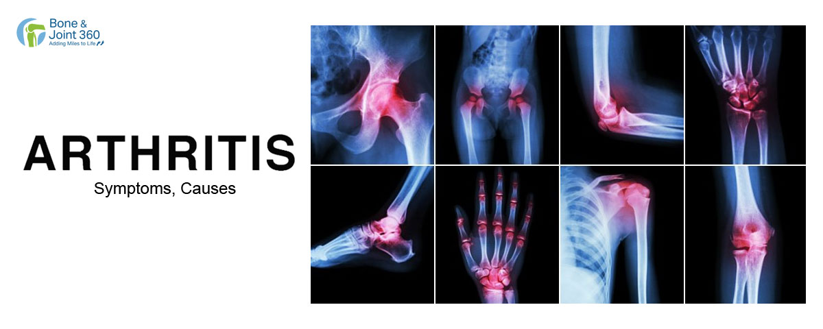 Arthritis Causes & Symptoms