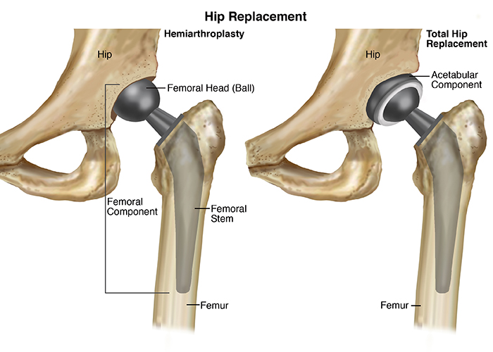 hip replacement implants
